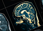 MRI Scan. Credit:iStock.com